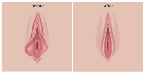 Labiaplasty surgery diagram