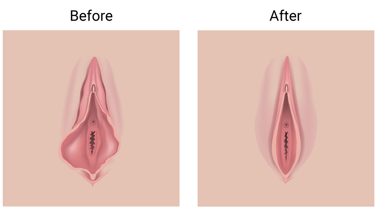 Labiaplasty Procedure 