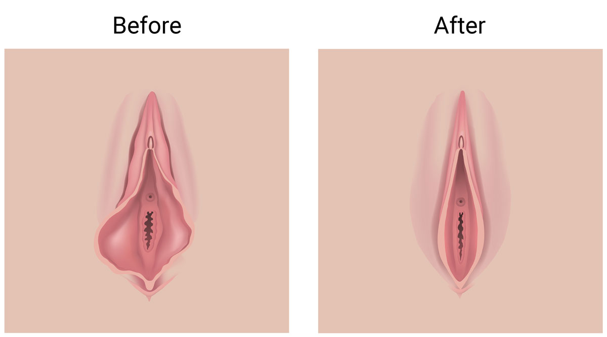 Labiaplasty surgery diagram